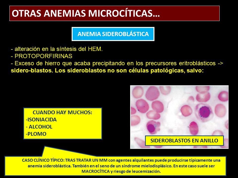 anemia sideroblastica caso clinico de diabetes